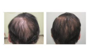 Before and After showing Dr. Glynis Ablon's Hair Regrowth Program