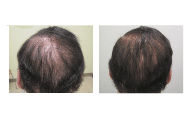Before and After showing Dr. Glynis Ablon's Hair Regrowth Program