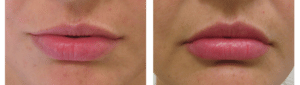 Lip Implants by Dr. Glynis Ablon, Ablon Institute.