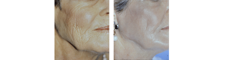 Results of Thermaphoto treatment at Ablon Institute.