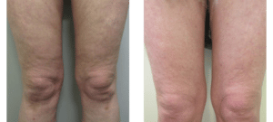 Before and after showing results of Endymed Pro RF / Tripollar RF treatments at Ablon Skin Institute