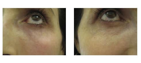 Before and After showing results of Tripollar RF treatment at Ablon Skin Institute