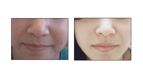 Results of Acne Treatments at Ablon Skin Institute, Manhattan Beach, CA