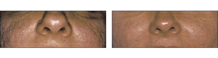 Acne Scar Treatment results (before & After) at Ablon Skin Institute