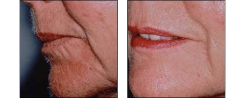 Lip Enhancements by Dr. Glynis Ablon, Ablon Institute.