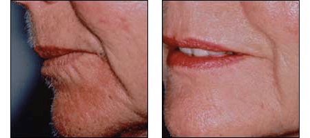 Before & After showing results of Botox treatment at Ablon Skin Institute.