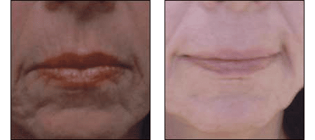 Before & After showing results of Botox treatment at Ablon Skin Institute.