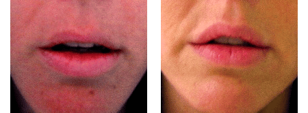 Before & After showing Butterfly Lip Lift by Dr. Glynis Ablon.