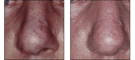 Facial Vein Treatments at Ablon Skin Institute, Manhattan Beach CA.