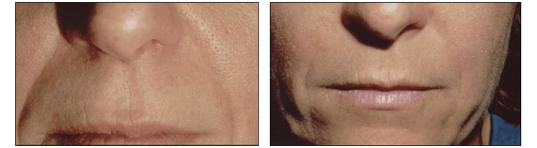 Results of fillers at Ablon Skin Institute.