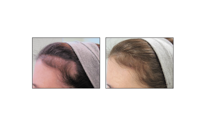 Dr. Glynis Ablon's hair regrowth program at Ablon Institute.