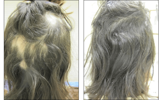 Dr. Glynis Ablon's hair regrowth program at Ablon Institute.