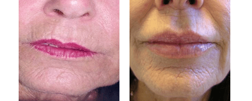 Lip Enhancements by Dr. Glynis Ablon, Ablon Institute.