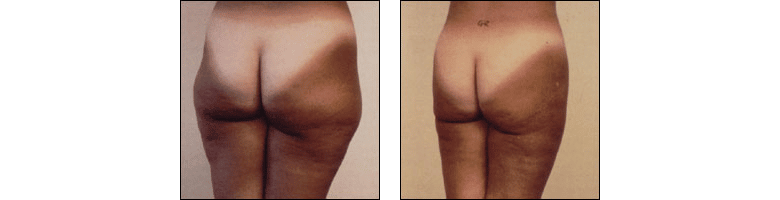 Liposhaping by Dr. Glynis Ablon at Ablon Institute.