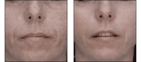 Results of Laser Resurfacing by Dr. Glynis Ablon of Ablon Institute.