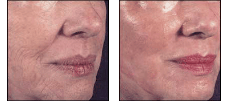 Results of Laser Resurfacing by Dr. Glynis Ablon of Ablon Institute.
