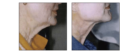 Neck Rejuvenation by Dr. Glynis Ablon of Ablon Skin Institute