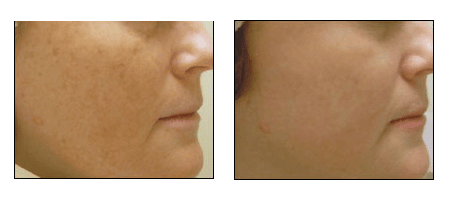 Photofacial rejueination at Ablon Skin Institute, Manhattan Beach CA