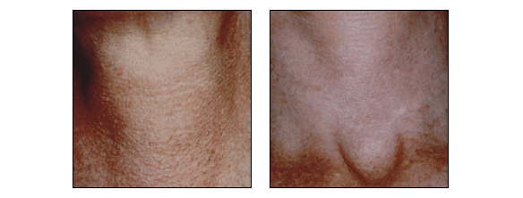 Photofacial rejuvenation at Ablon Skin Insitute