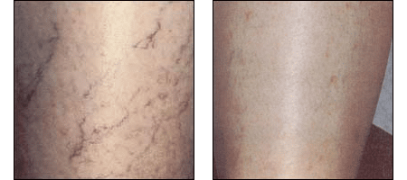Results of Leg Vein Treatments at Ablon Institute.