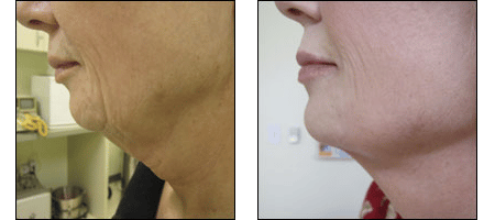 Results of the Ablon Skin Snip for neck rejuvenation