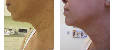 Results of the Ablon Skin Snip for neck rejuvenation