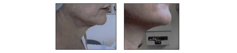 Tighter skin with Thermage Treatment by Dr. Glynis Ablon at Ablon Skin Institute