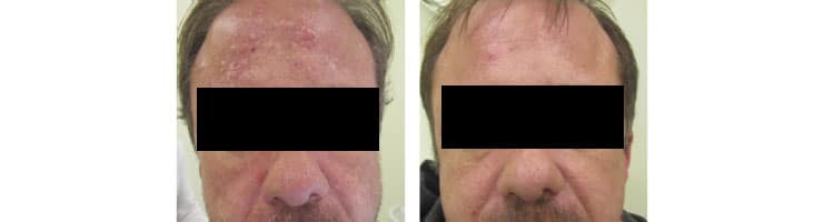 Thermaphoto Before & After image from Ablon Skin Institute.