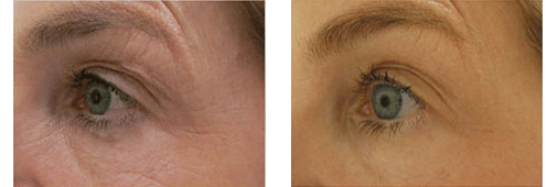 Before and After showing results of Thermismooth Treatment by Dr. Glynis Ablon at Ablon Skin Institute