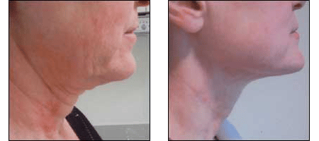 Patient results of Instalift, the non-surgical facelift alternative at Ablon Skin Institute