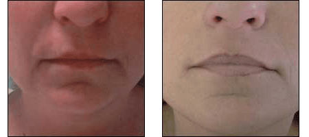 Patient results of Instalift, the non-surgical facelift alternative at Ablon Skin Institute