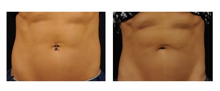 Accufit Before & After