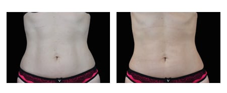 EMSCULPT NEO BEFORE AND AFTER